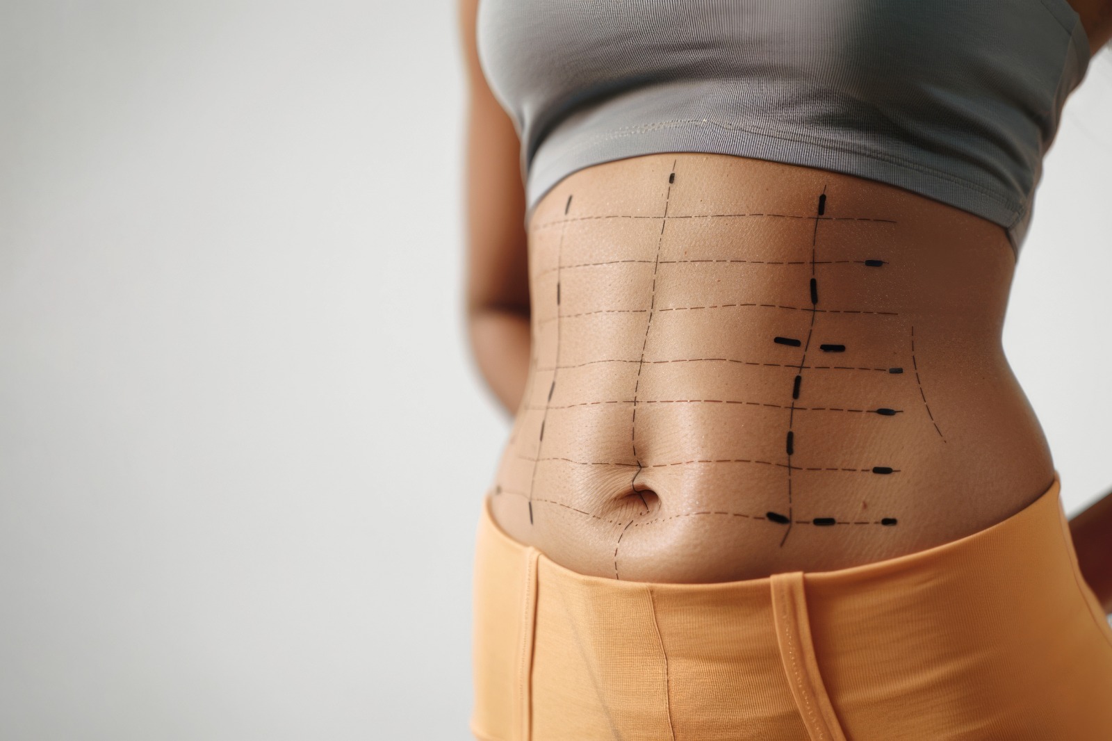 Abdominoplasty — Advanced tummy tuck procedures for body contouring by Dr. Umesh N, Serenova Aesthetics, Bangalore